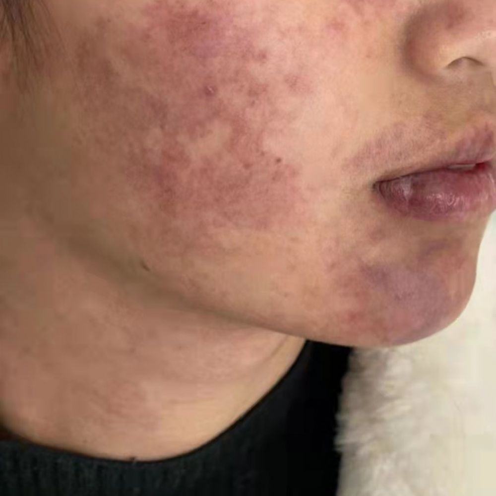 鲜红斑痣治疗三次后的效果