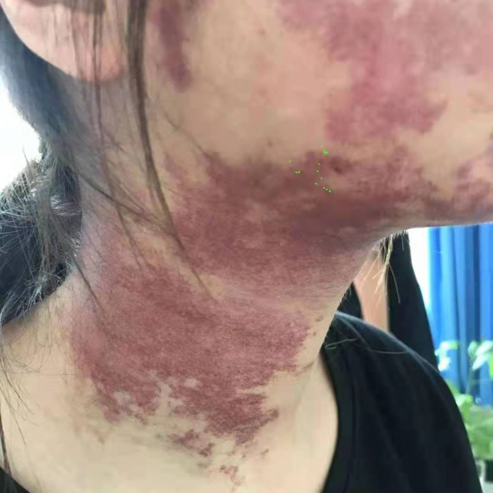 鲜红斑痣治疗三次后的效果